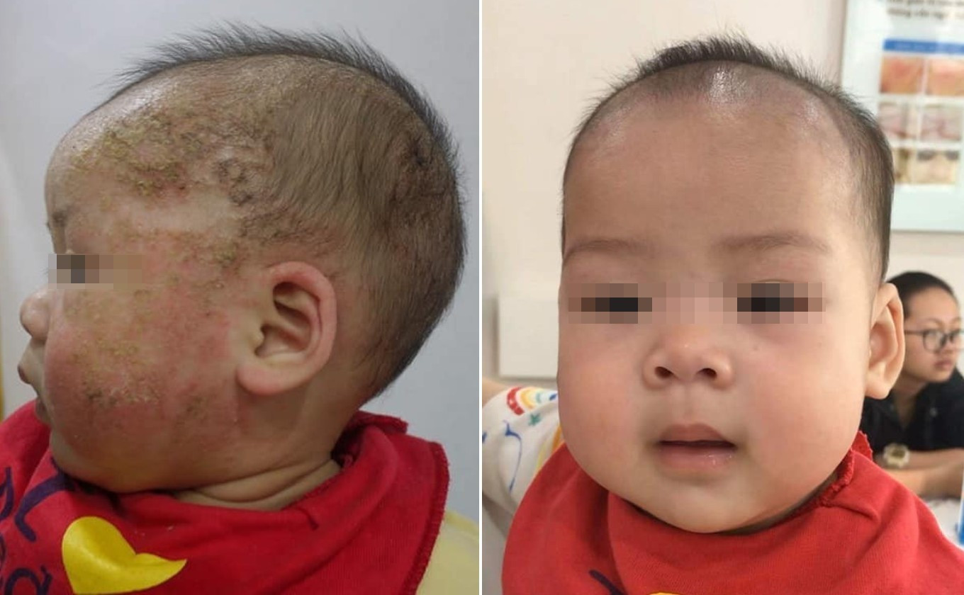 Bé trai 8 tháng tuổi biến chứng nặng do điều trị viêm da cơ địa sai cách, gia đình tá hỏa khi biết điều này - Ảnh 1.