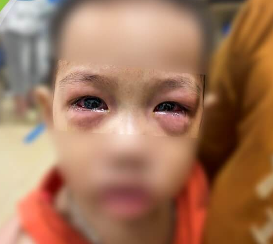 Hàng chục trẻ đau mắt đỏ nhập viện, chuyên gia cảnh báo biến chứng nặng - Ảnh 1.