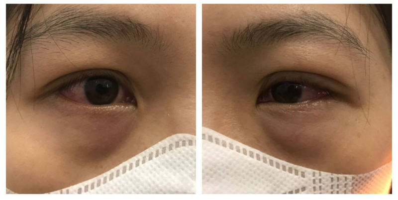 Đau mắt đỏ nhưng chủ quan, nhiều người biến chứng viêm giác mạc, giảm thị lực - Ảnh 2.