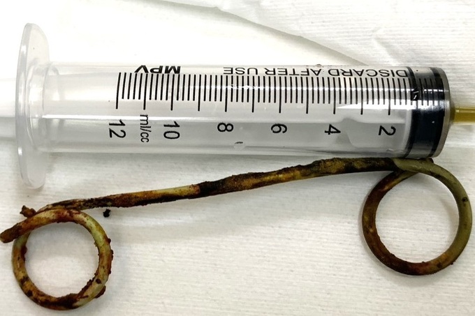 Stent dài 15cm bị bỏ quên trong ống mật của cụ bà suốt 6 năm - Ảnh 1.