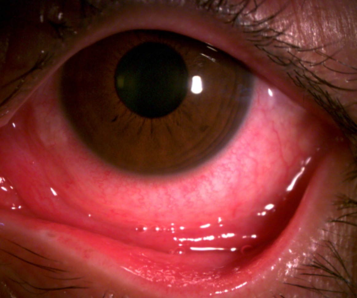 Đau mắt đỏ bùng phát, điều trị không đúng có thể gây biến chứng dẫn đến mất thị lực - Ảnh 1.