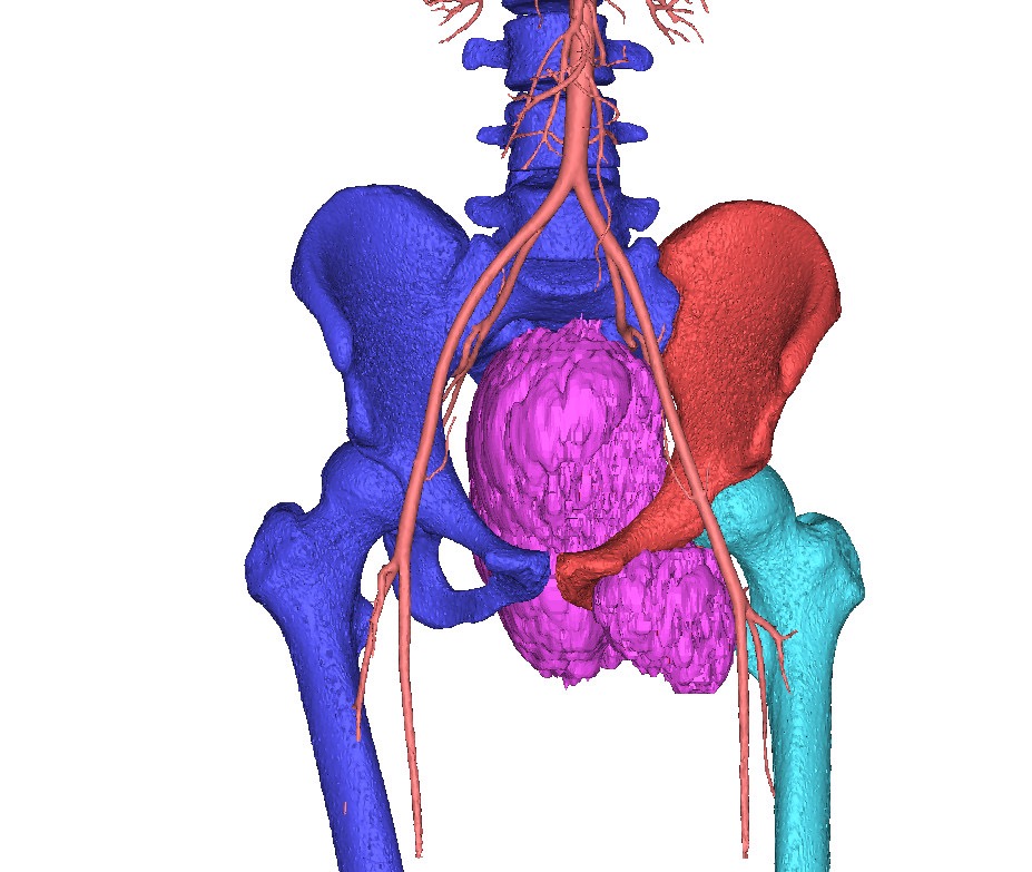 Khối u khổng lồ hơn 20cm