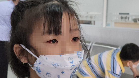 Hơn 71.000 ca đau mắt đỏ, Sở Y tế TP.HCM khẩn trương tìm tác nhân gây bệnh - Ảnh 1.