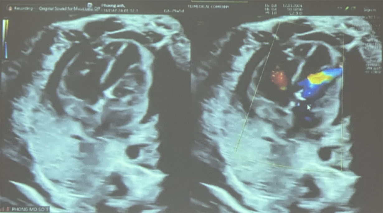 Can thiệp xuyên tử cung cứu sống bào thai 29 tuần tuổi bị tim bẩm sinh rất nặng- Ảnh 3.