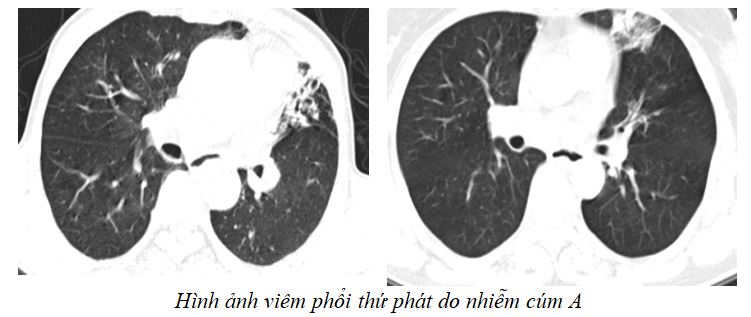 Trời lạnh, cảnh giác với cúm A, đặc biệt ở người già, trẻ nhỏ- Ảnh 3.