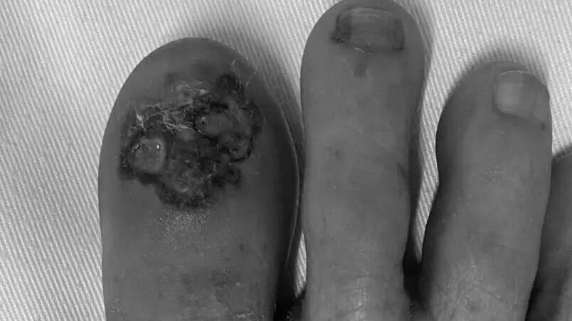 Ngón chân đen nhánh, lở loét vì ung thư da nguy hiểm- Ảnh 2.