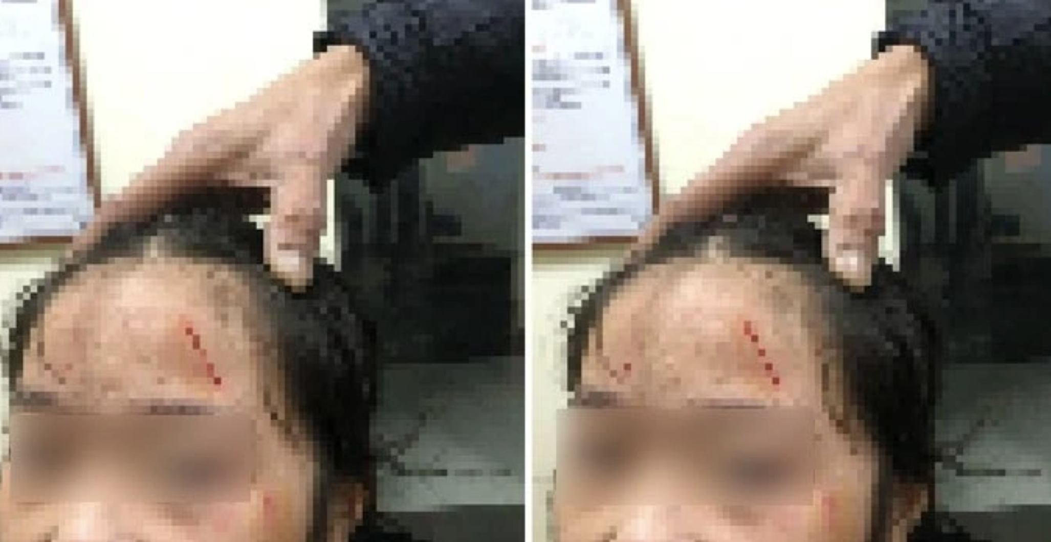 Mẹ của nữ sinh lớp 6 bị bạn đánh rách mặt ở Hà Nội: "Con tôi cứ hoảng loạn, hét lên"- Ảnh 2.