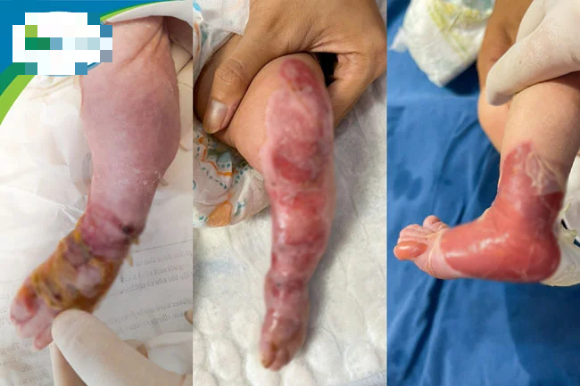 Bệnh hiếm khiến toàn bộ cẳng chân bé 13 ngày tuổi như bị "lột da"- Ảnh 1.