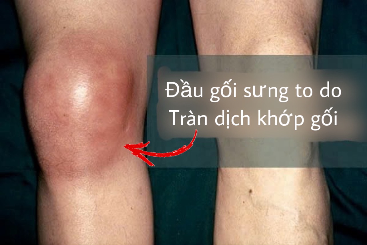 "Trẻ hóa khớp gối" ở phòng khám tư, 2 phụ nữ suýt tê liệt- Ảnh 1.