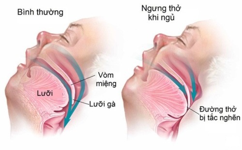 Nguy hiểm hội chứng ngưng thở khi ngủ - Ảnh 1.