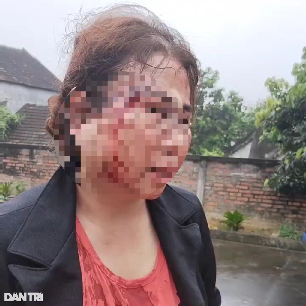 Người phụ nữ bị chồng kém 11 tuổi bạo hành nhập viện trước ngày ra tòa ly hôn- Ảnh 2.