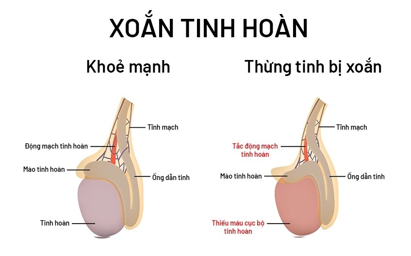 Đang ngủ đau dữ dội vùng kín, thiếu niên suýt mất "nam tính" vì bệnh hiểm- Ảnh 1.