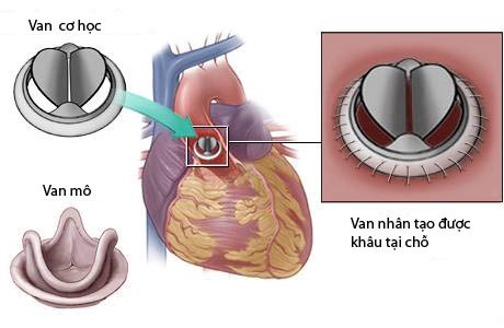 Kẹt van tim nhân tạo suýt chết vì không đi tái khám định kỳ- Ảnh 1.