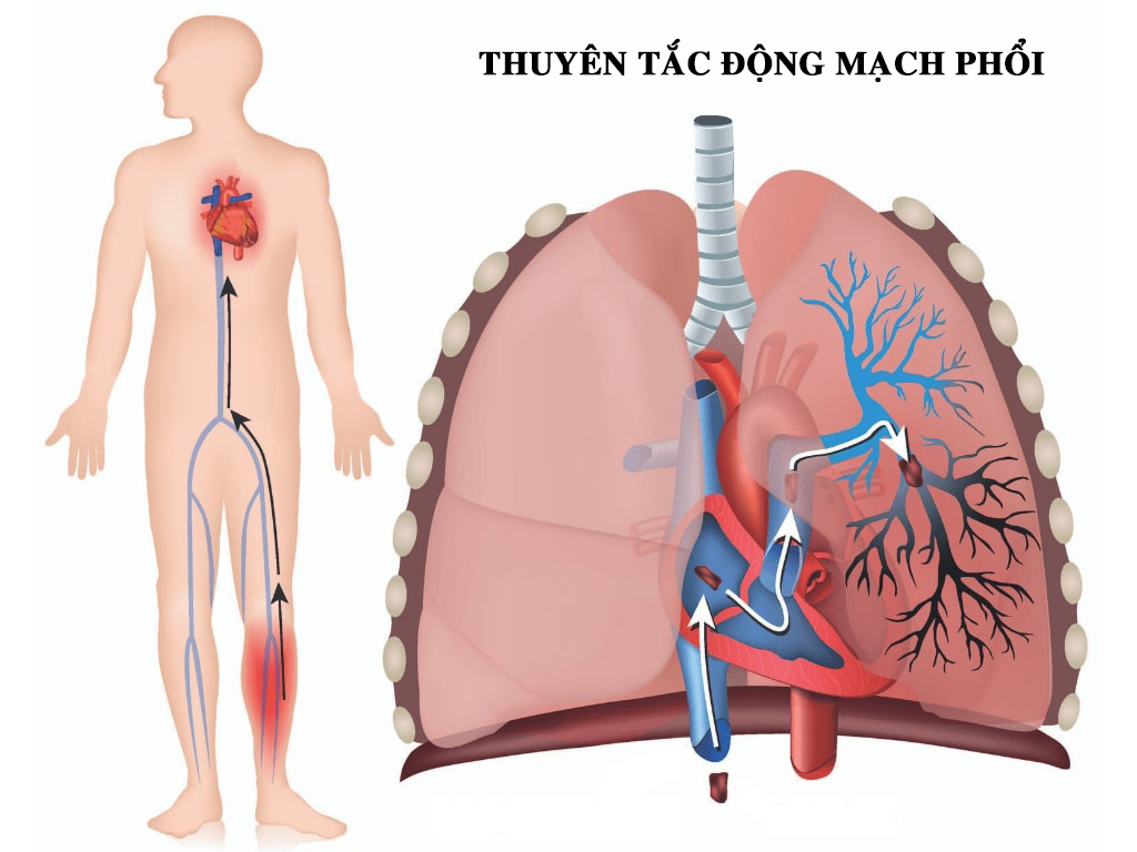 Sốc, tụt huyết áp nguy hiểm vì "sát thủ ẩn mình"- Ảnh 2.