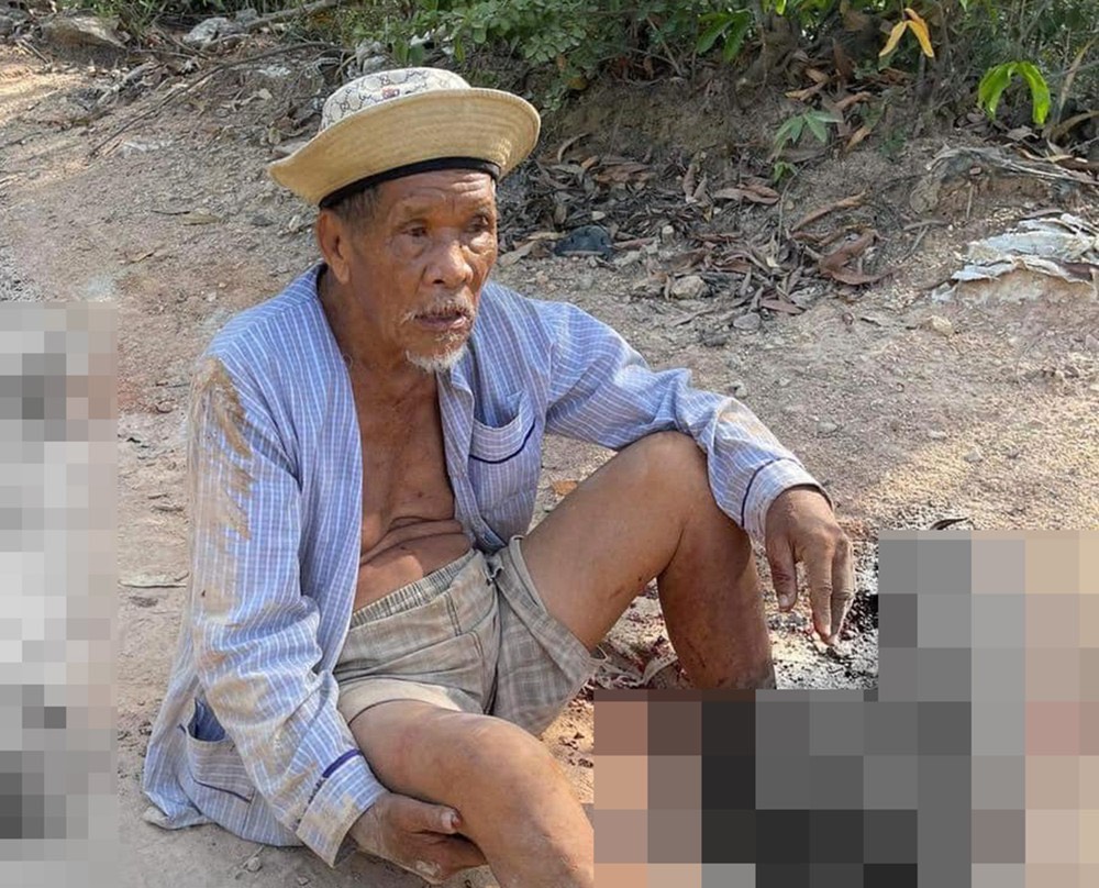 Cụ ông 85 tuổi ở Bình Định bị xe ben "lạ" tông nát chân- Ảnh 1.