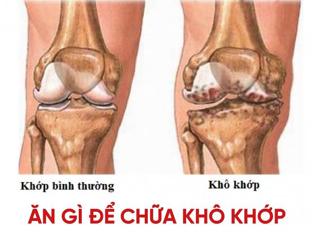 Khô khớp gối, lục khục khớp nên ăn gì giúp tái tạo sụn, tăng dịch khớp?