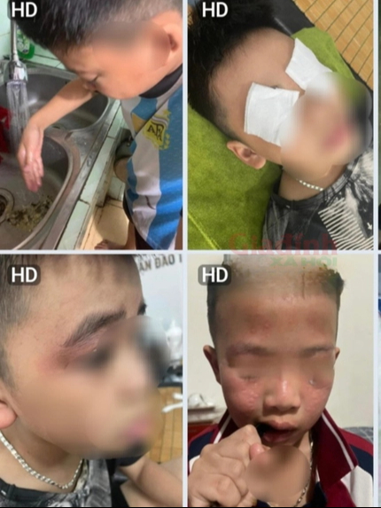 Hà Nội: Nhiều học sinh mẩn ngứa, rát mắt sau khi nhà trường phun thuốc diệt muỗi- Ảnh 1.