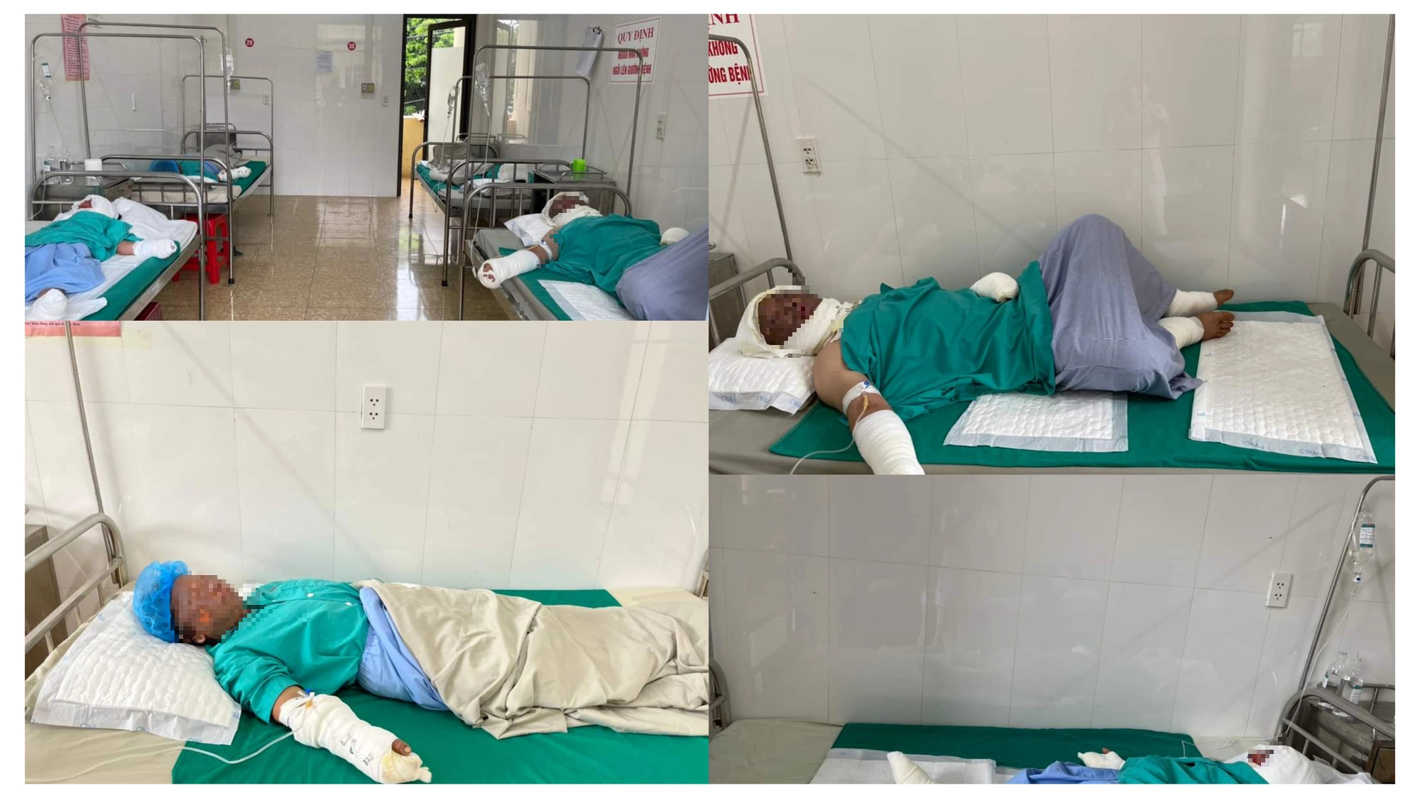 Nổ bình gas ở Yên Bái khiến gia đình 4 người bỏng nặng, 1 cháu bé phải chuyển Bệnh viện Bỏng Quốc gia- Ảnh 1.