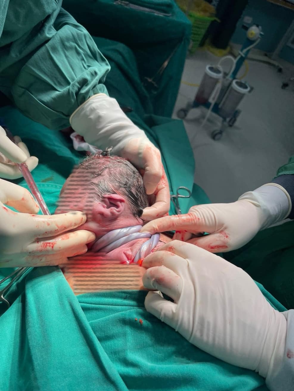 Khẩn cấp phẫu thuật cứu thai nhi bị dây nhau quấn cổ 3 vòng- Ảnh 1.