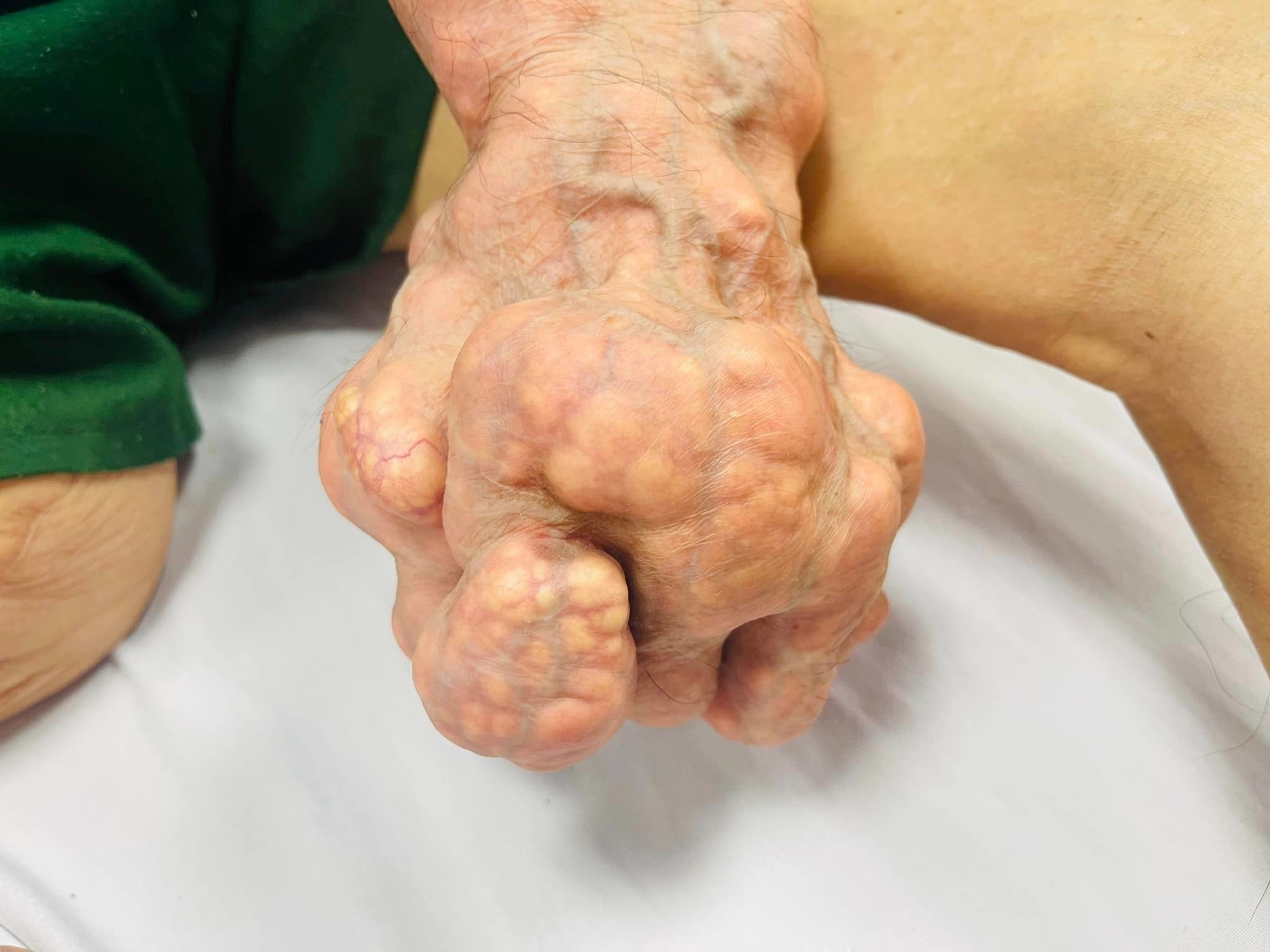 Sửng sốt với đôi tay biến dạng, u cục lồi lõm do gout nặng- Ảnh 2.
