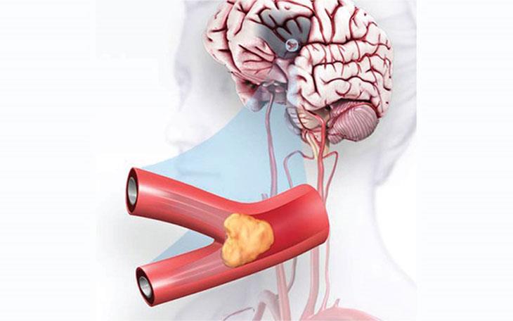 Cẩn trọng cơn thiếu máu não thoáng qua và cách cải thiện cùng Nattospes- Ảnh 2.