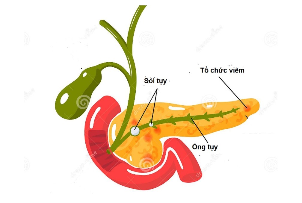 Viêm tụy cấp - bệnh nguy hiểm "từ miệng mà ra" - Ảnh 1.