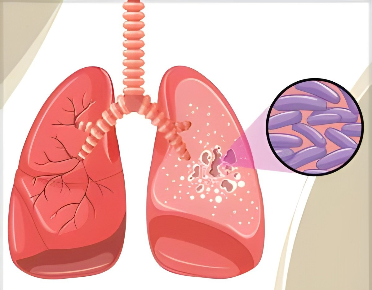 Đi khám sức khỏe, tá hỏa khi biết mình mắc lao phổi - Ảnh 2.