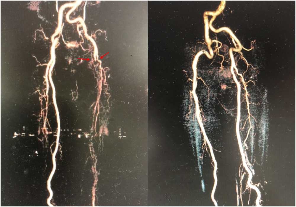 Loại bỏ 25cm huyết khối động mạch đùi, "cứu chân" cho cụ ông U90- Ảnh 2.