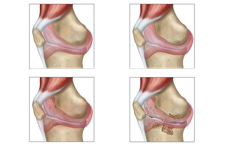 Bệnh viêm khớp dạng thấp: Mức độ nguy hiểm và giải pháp cải thiện từ Hoàng Thấp Linh- Ảnh 1.