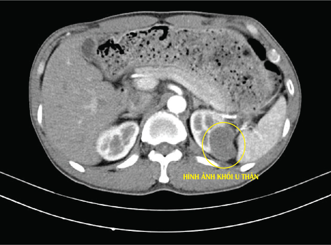 Đau tức mạn sườn, tiểu ra máu không ngờ bị u thận- Ảnh 1.
