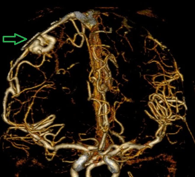 Thiếu niên 15 tuổi đột ngột tử vong vì dị dạng mạch máu não- Ảnh 2.