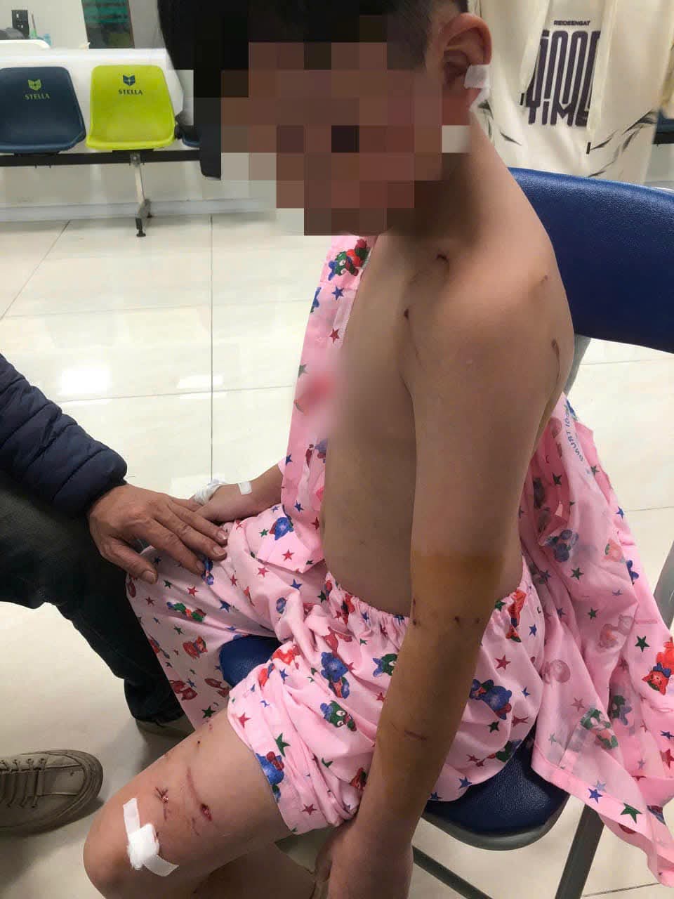 Bé trai bị chó tấn công khi đi chúc Tết, khâu 9 mũi- Ảnh 1.