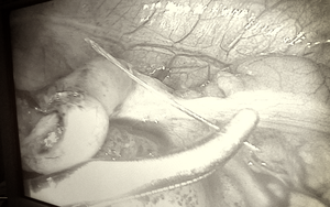 Cà Mau: Xương cá xuyên thủng ruột thừa