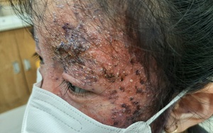 Bé gái 8 tuổi bị tổn thương nửa khuôn mặt do tự bôi thuốc trị nấm