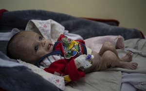 Rơi nước mắt những đứa trẻ gầy trơ xương vì đói phải nhập viện cấp cứu ở Afghanistan