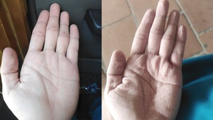 Những đôi bàn tay "biến dạng" tại tâm dịch Covid-19 