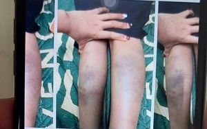 Đà Nẵng: Giáo viên ngất xỉu khi làm việc với gia đình học sinh bị đánh bầm tím tay chân