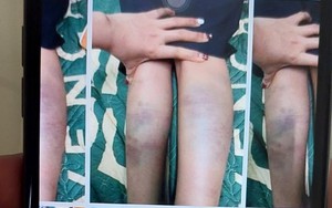 Xác định nguyên nhân học sinh tiểu học tại Đà Nẵng bị đánh bầm tím tay chân