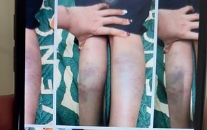 Vụ học sinh bị đánh bầm tím tay chân ở Đà Nẵng: &quot;Không tin con mình đánh bạn như vậy&quot;