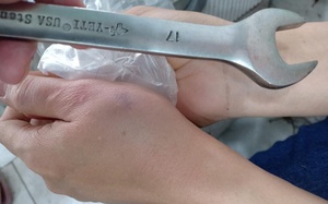 Kinh hãi: Người phụ nữ bế con nhỏ 2 tuổi bị cờ lê "từ trên trời rơi xuống" trúng gãy ngón tay 