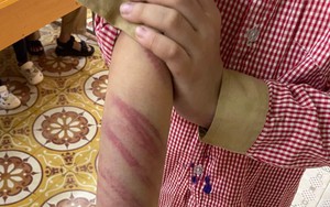 Hải Phòng: Bé trai 8 tuổi sống với mẹ và bố dượng bị bạo hành tím bầm toàn thân 