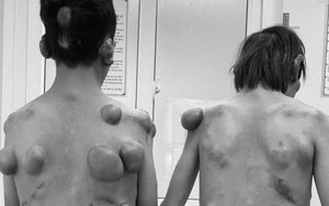 Bệnh quái khiến hàng trăm khối u mọc chi chít trên thân thể của 2 anh em sinh đôi 