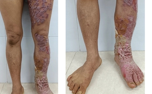 Nhiễm nấm da nghiêm trọng, một nông dân biến dạng chân, đi lại khó khăn