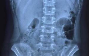 3 bệnh nhi ở Hải Phòng mắc Covid-19 bị thủng dạ dày