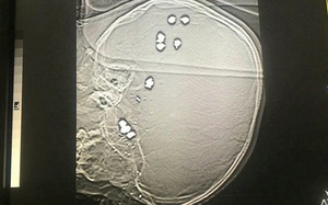 Xót xa bé trai 6 tuổi bị 11 viên đạn găm vào đầu tử vong