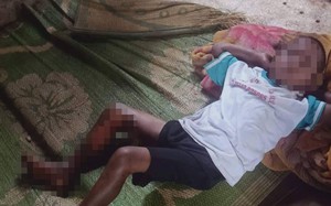 Bé trai 8 tuổi nghi bị đốt bỏng chân ở Đắk Lắk chỉ là do... tai nạn