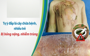 Cha mẹ đắp lá cây tự chữa bỏng cho trẻ, bệnh nhi nhiễm trùng nặng