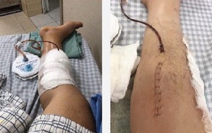 Thanh niên suýt mất chân vì tự ý dùng thuốc Đông- Tây y chữa đau khớp