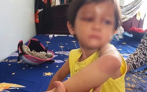 Bắt tạm giam cha nuôi hành hạ bé gái 4 tuổi ở Cà Mau