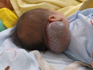 Phẫu thuật khối u khổng lồ hiếm gặp cho bé sơ sinh 14 ngày tuổi